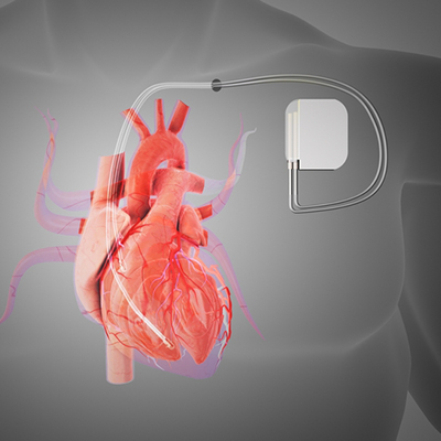 Pacemaker Implantation