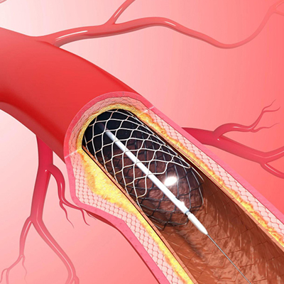 Percutaneous Coronary Intervention (PCI)