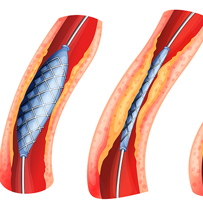Peripheral Artery Intervention